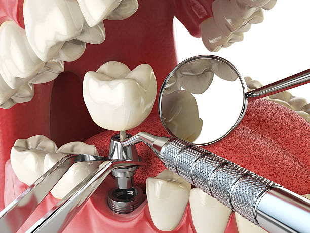 Best Emergency Cosmetic Dentistry (e.g., broken veneers) in Butte, AK